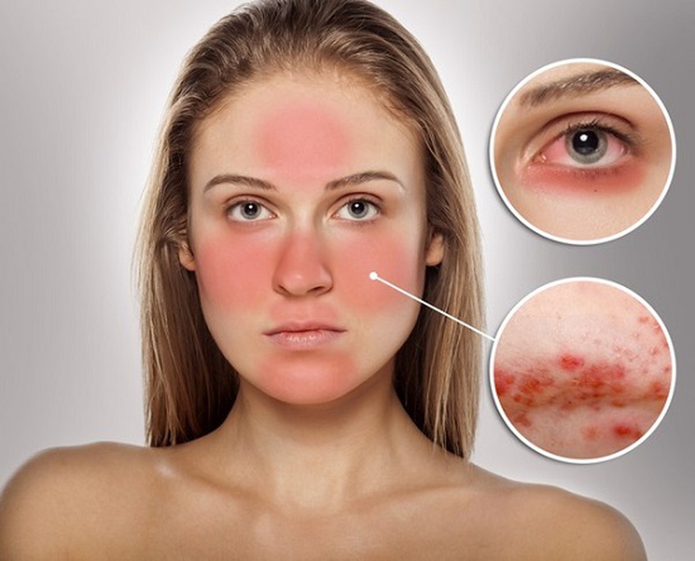 Hình ảnh minh họa hậu quả của việc đắp mặt nạ sai cách