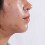 Hình ảnh da dầu