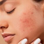 Gợi ý cho các nàng cách bôi kem chống nắng không bị mụn để da luôn mịn màng