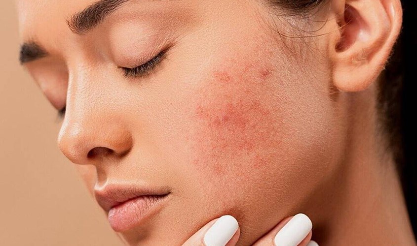 Gợi ý cho các nàng cách bôi kem chống nắng không bị mụn để da luôn mịn màng