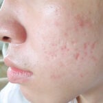 Làn da sau nặn mụn rất dễ bị tổn thương