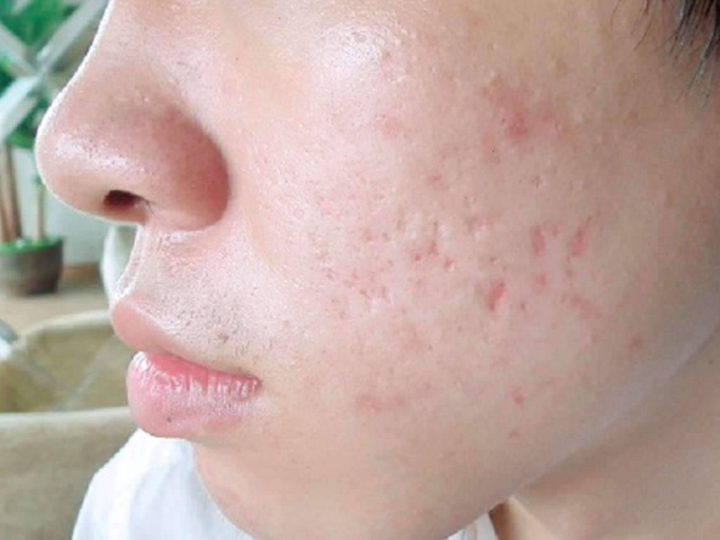Làn da sau nặn mụn rất dễ bị tổn thương