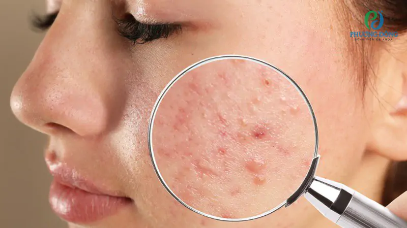 Hình ảnh mụn trứng cá