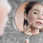 Tại Sao Bị Nám Da Mặt?